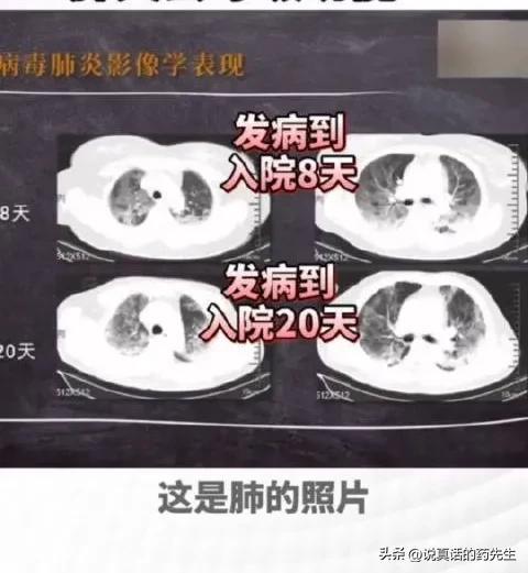 感染新冠后出现白肺真的是重症肺炎的表现？如何治疗？为何恐惧？