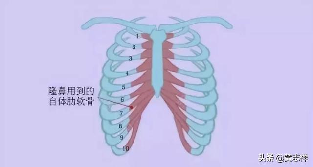 自体软骨隆鼻手術的注意事项