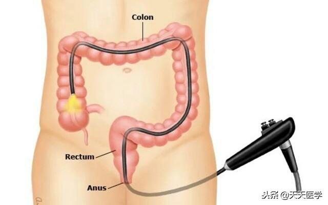 人们常说的结肠炎是什么情况，该如何正确治疗
