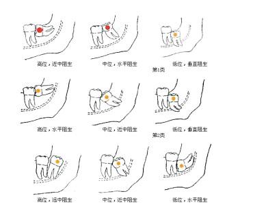 是什么原因引起长智齿？教你轻松判断自己有没有长