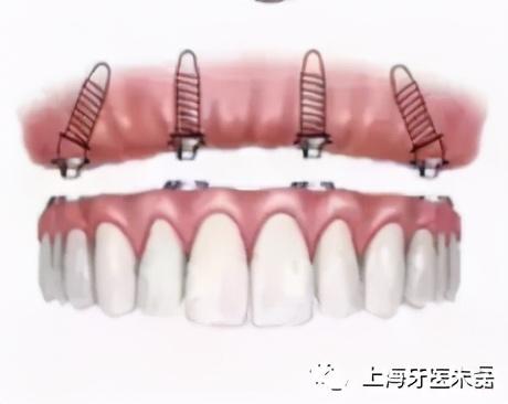 什么是ALL-ON-4（6）即刻种植？