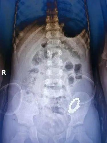 宁夏4岁男童吞下21颗磁力珠，造成6处肠穿孔