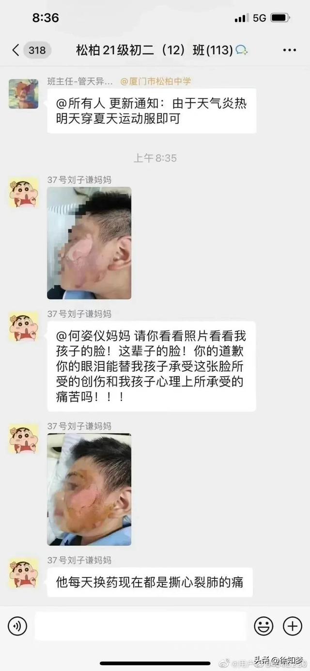 女生朝男生泼滚水致其毁容后续，学校:正在沟通