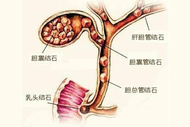 胆囊切除有啥后遗症？医生提醒：这3种后遗症较常见，能不切别切