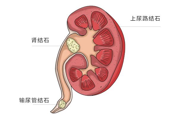 为什么大笑会漏尿？女性漏尿不能忽视，如此改善更有效